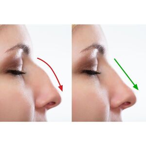 Southampton Nose Filler Experts - Southampton, Hampshire, United Kingdom